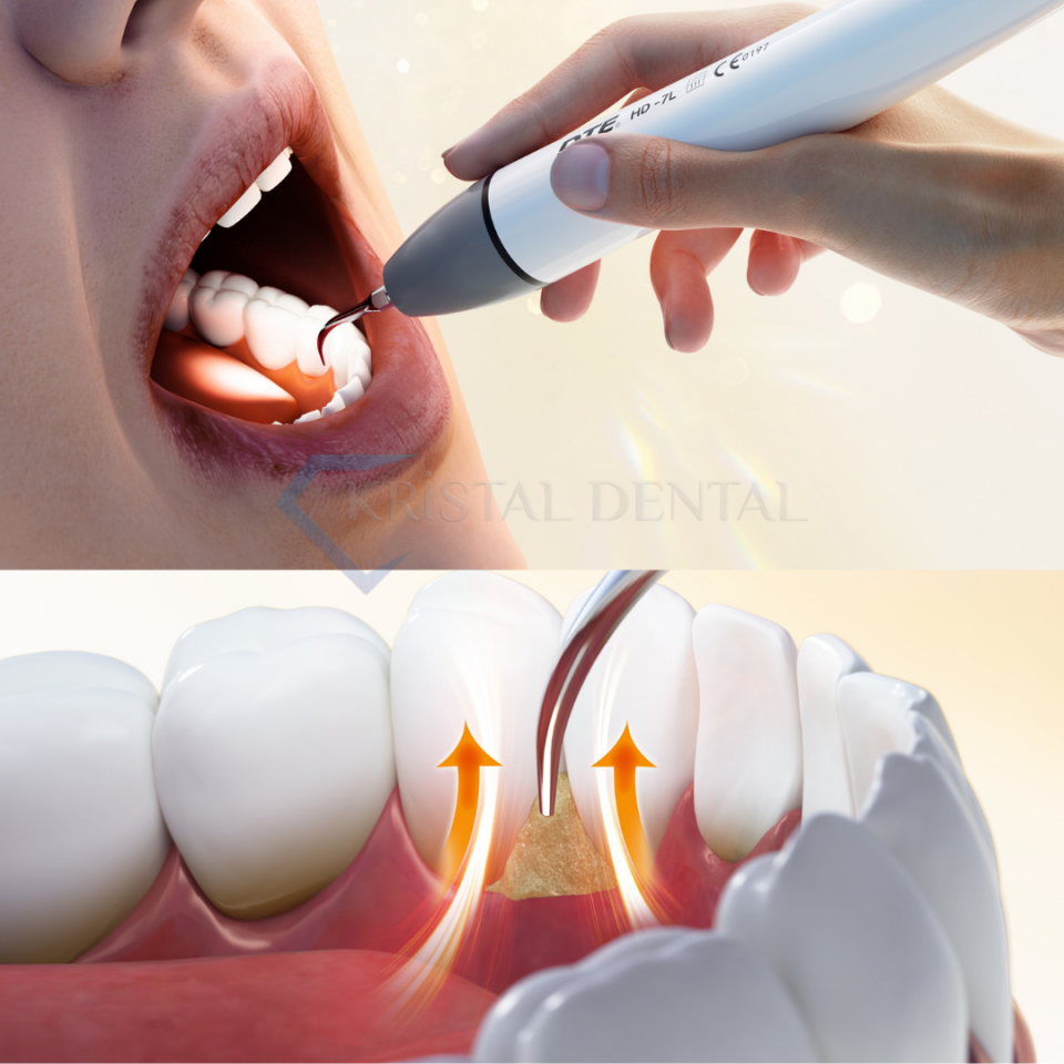 Woodpecker/Dte D8 LED Işıklı Su Hazneli Kavitron